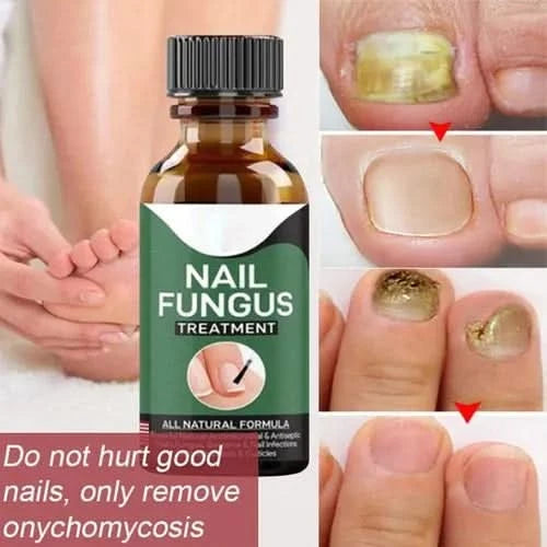 Nail Fungal Repair Serum | Nail Fungus Removal Gel - Pakpick