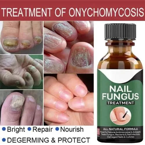 Nail Fungal Repair Serum | Nail Fungus Removal Gel - Pakpick