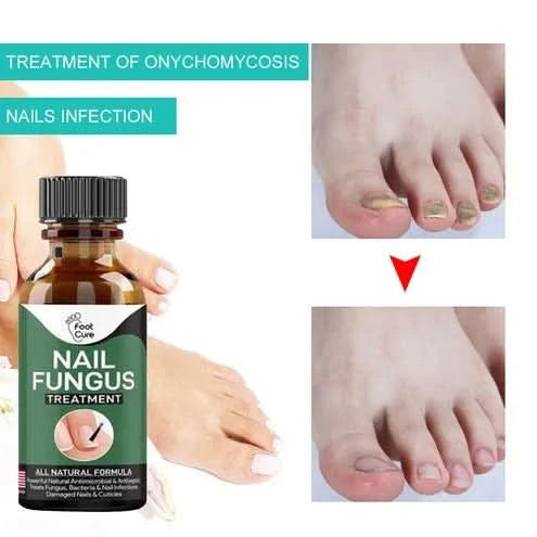 Nail Fungal Repair Serum | Nail Fungus Removal Gel - Pakpick
