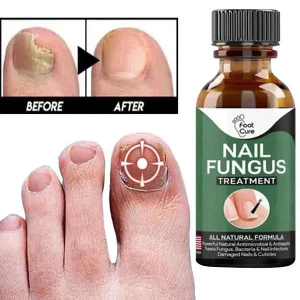 Nail Fungal Repair Serum | Nail Fungus Removal Gel - Pakpick